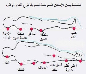 قرح الفراش